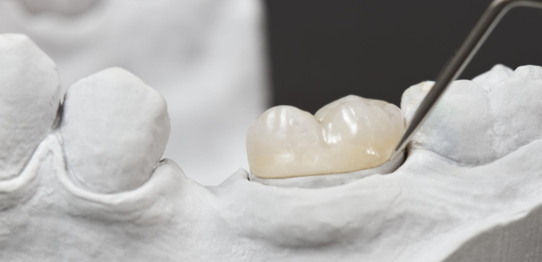 Inlays and Onlays: Precision Restorations at Dream Smile of Norcross