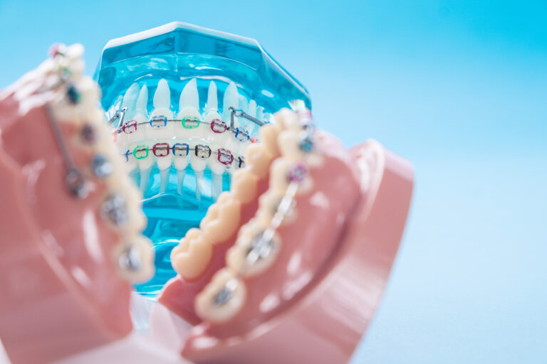 Permanent Retainers: A Long-Term Solution for Smile Maintenance at Dream Smile of Norcross